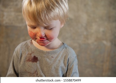 Little Fair-haired Boy Is Smeared With Blood. Baby Has Weak Vessels In Nose Bursting With Pressure Drops And Changes In Weather. Hemophilia Disease. Blond Child Lifts His Head To Stop The Bleeding