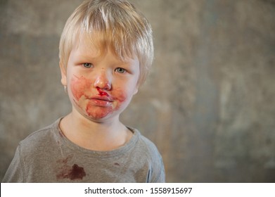 Little Fair-haired Boy Is Smeared With Blood. Baby Has Weak Vessels In Nose Bursting With Pressure Drops And Changes In Weather. Hemophilia Disease. Blond Child Lifts His Head To Stop The Bleeding