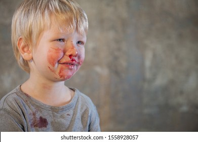 Little Fair-haired Boy Is Smeared With Blood. Baby Has Weak Vessels In Nose Bursting With Pressure Drops And Changes In Weather. Hemophilia Disease. Blond Child Lifts His Head To Stop The Bleeding