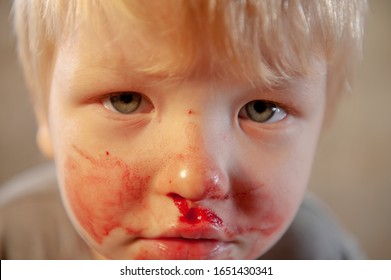 Little Fair-haired Boy Is Smeared With Blood. Baby Has Weak Vessels In Nose Bursting With Pressure Drops And Changes In Weather. Hemophilia Disease. Blond Child Lifts His Head To Stop The Bleeding