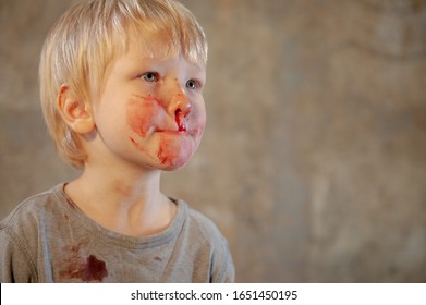 Little Fair-haired Boy Is Smeared With Blood. Baby Has Weak Vessels In Nose Bursting With Pressure Drops And Changes In Weather. Hemophilia Disease. Blond Child Lifts His Head To Stop The Bleeding