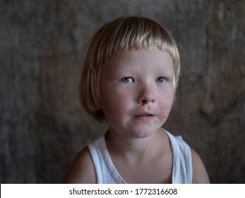 Little Fair-haired Boy Is Smeared With Blood. Baby Has Weak Vessels In Nose Bursting With Pressure Drops And Changes In Weather. Hemophilia Disease. Blond Child Lifts His Head To Stop The Bleeding