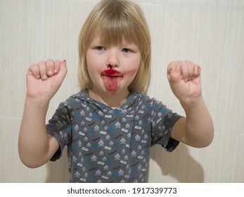 Little Fair-haired Boy Is Smeared With Blood. Baby Has Weak Vessels In Nose Bursting With Pressure Drops And Changes In Weather. Hemophilia Disease. Blond Child Lifts His Head To Stop The Bleeding