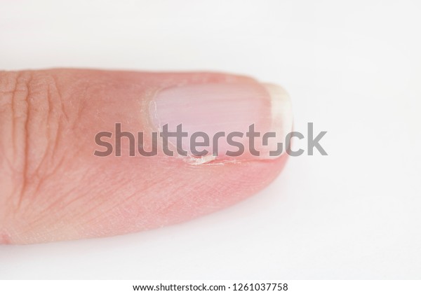 Little Finger Hangnail Stock Photo (Edit Now) 1261037758