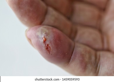 The Little Finger Is Swollen. This Wound Is Produced By The Bite Of A Poisonous Spider. The Effects Produced From These Poisons Include Pain, Burning Sensation, Dizziness And Nausea