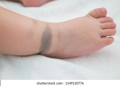 The Little Foot With Birthmark. This Birthmark Will Disappear In The Future. (Called Mongolian Spot)