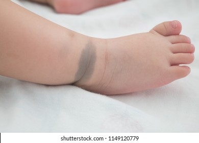 The Little Foot With Birthmark. This Birthmark Will Disappear In The Future. (Called Mongolian Spot)