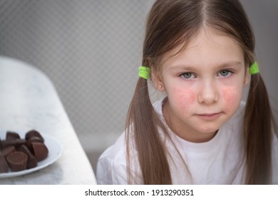 A Little Girl With An Allergic Rash On Her Cheeks Sits At A Table Next To Chocolates. Allergy Skin Baby Dermatitis Symptom Food. Child Problem Rash	