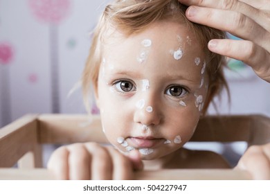 Little Girl With Chickenpox, Antiseptic Cream Applied To Rash