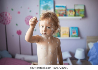 Little Girl With Chickenpox, Antiseptic Cream Applied To Rash