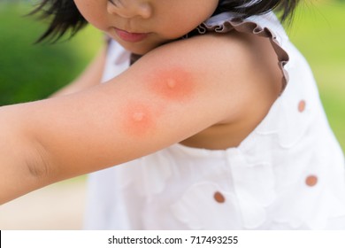 Little girl has allergies with mosquitoes bite and itching her arm.Mosquito blood breeding on kids.Repellent, Dengue virus, Yellow fever, West nile, Malaria, Diseases Spread by Mosquitoes concept.