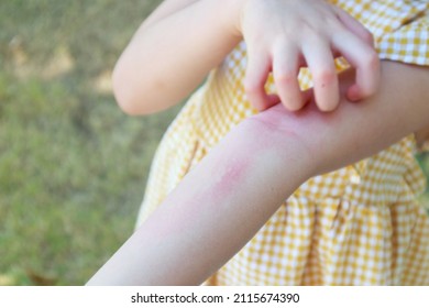 Little girl has skin rash allergy and itchy on her arm