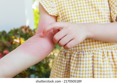 Little Girl Has Skin Rash Allergy And Itchy On Her Arm