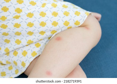 Little Girl Has Skin Rash Allergy Itching On Her Leg