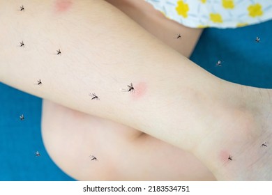 Little Girl Has Skin Rash Allergy Itching On Her Leg With Mosquitoes Bite