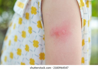 Little Girl Has Skin Rash Allergy Stock Photo 2183964547 | Shutterstock