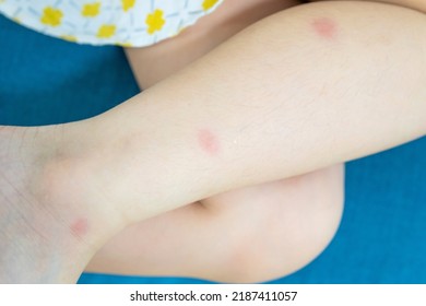 Little Girl Has Skin Rash Allergy Itching On Her Leg