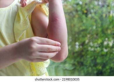 Little Girl Has Skin Rash Allergy And Itchy On Her Arm