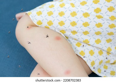 Little Girl Has Skin Rash Allergy Itching On Her Leg With Mosquitoes Bite