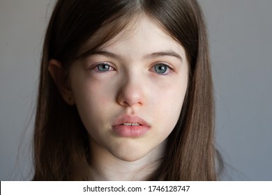 A little girl with red watery eyes, she has a sickly look, a virus, a cold, swollen eyes, an allergy