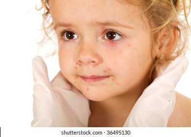 Little Girl With Small Pox At The Doctors Examination - Isolated, Closeup