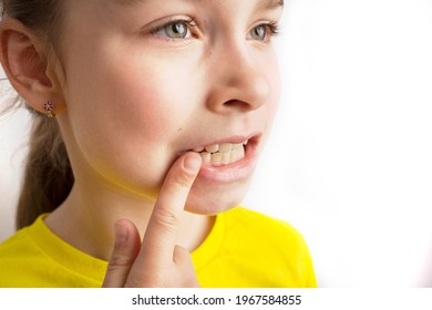 Little Girl Stands On A White Background With A Beautiful Smile, Children Crooked Teeth, Pediatric Dentistry. Crooked Teeth Close-up. Correction Of Malocclusion Is Required.