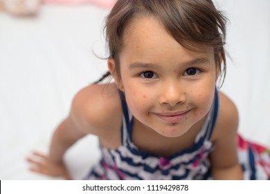 Little Girl With Varicella, Chicken Pox, Small Pox.