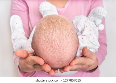 Little Newborn Baby With Psoriasis Or Dandruff In The Hair