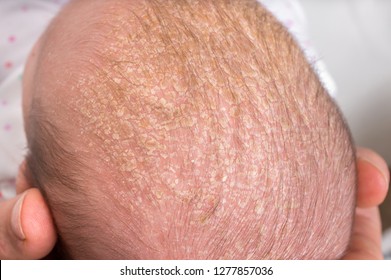 Little Newborn Baby With Psoriasis Or Dandruff In The Hair