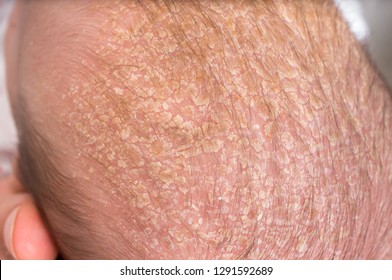 Little Newborn Baby With Psoriasis Or Dandruff In The Hair