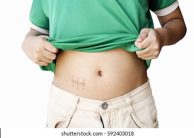 Little pointing scar after appendectomy,clipping path on white background.
