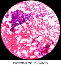 Liver Cancer: Hepatocellular Carcinoma (hepatoma), Malignant Cells. Atypical Hepatocytes Arranged In Clusters, Background Inflammatory Cells And Blood.