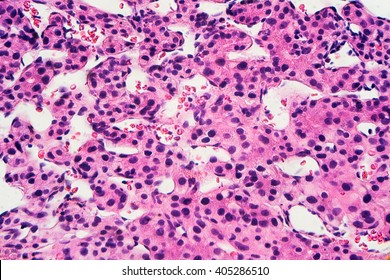 Liver Cancer: Hepatocellular Carcinoma (hepatoma) Is A Malignant Tumor  Often Associated With Chronic Hepatitis B (photographed And Uploaded By US Board Certified Surgical Pathologist).