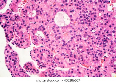 Liver Cancer (microscopic):  Hepatocellular Carcinoma (hepatoma) Is A Malignant Tumor  Often Associated With Chronic Hepatitis B (photographed And Uploaded By US Board Certified Surgical Pathologist).