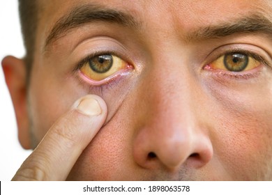 Liver disease. Young man face with yellowish eyes and skin. Sign of problems with liver. Symptoms of high bilirubin, jaundice, hepatosis, hepatitis, cirrhosis, liver failure - Shutterstock ID 1898063578