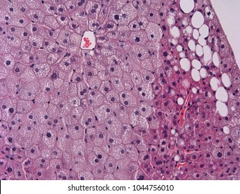 Liver steatosis due to a diet rich in fats.