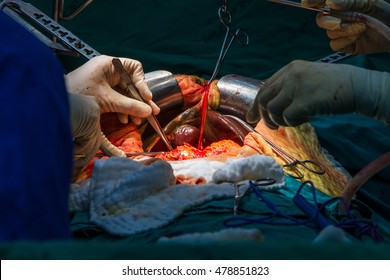  Liver transplant  in  operating  room, Surgery