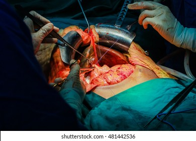 Liver Transplant In Operating Room, Surgery In Hospital