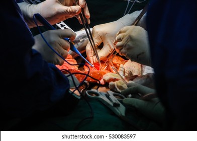 Liver transplant in operating room, Surgery in hospital