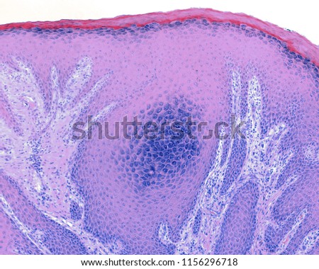 LM micrograph of a papilloma, caused by human papillomavirus (HPV). The stratum granulosum is plenty of keratohyalin granules (hypergranulosis). The dermis show a intense inflammatory infiltrate.
