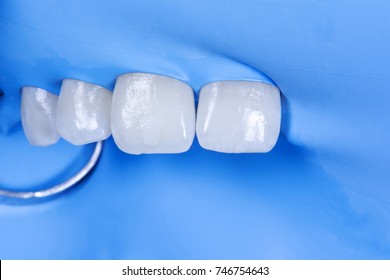 Local Tooth Enamel Hypoplasia. Tooth Isolated With Raberdam. Surface After Remineralization.