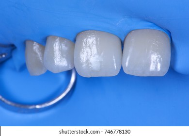 Local Tooth Enamel Hypoplasia. Tooth Isolated With Raberdam.