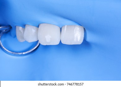 Local Tooth Enamel Hypoplasia. Tooth Isolated With Raberdam. Surface After Acid Preparing