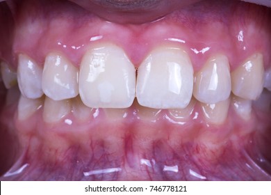 Local Tooth Enamel Hypoplasia Surface After Stock Photo 746778121