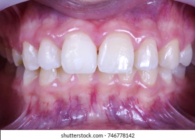 Local Tooth Enamel Hypoplasia. Surface After Remineralization.