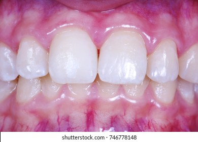 Local Tooth Enamel Hypoplasia. Surface After Remineralization.