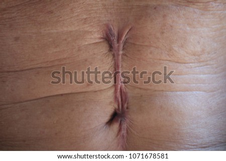 Long abdominal scars
