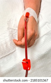 A Long Covid Patient Undergoing Extracorporeal Blood Oxygenation And Ozonation With Filtration. Similar To Dialysis Wherein The Blood Is Removed From One Arm, Cleansed, Then Returned To The Other Arm.