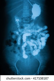 Long Gastrointestinal Series (Upper GI And Small Bowel), A 72 Year Old Women, 30 Mines