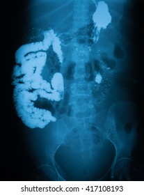 Long Gastrointestinal Series (Upper GI And Small Bowel), A 72 Year Old Women, 2 Hour Delay